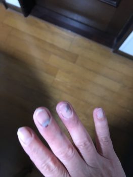 雨戸に指を挟む